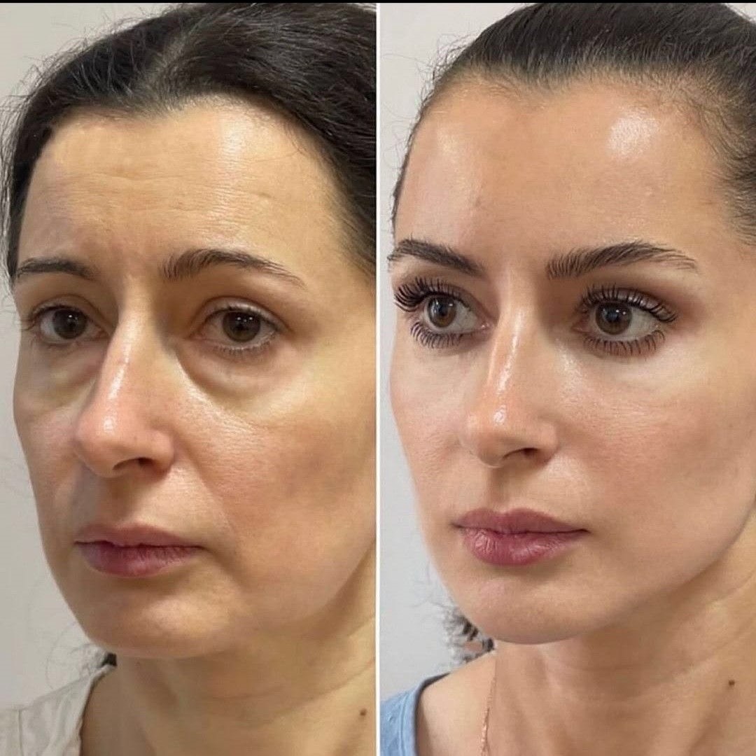 Upper Face & Eye Area